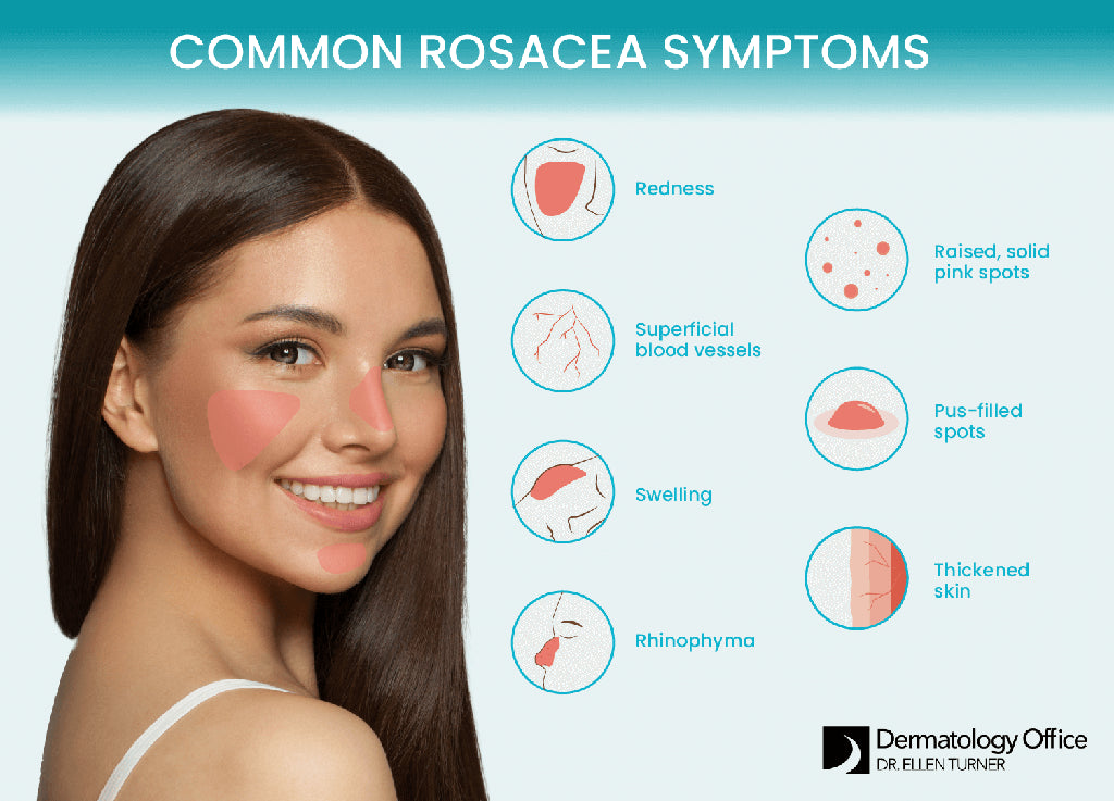 Rosacea – The Inflammatory Skin Condition We Can Help With!